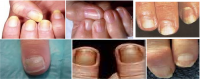ANORMALIDADES  DE  LAS  UÑAS